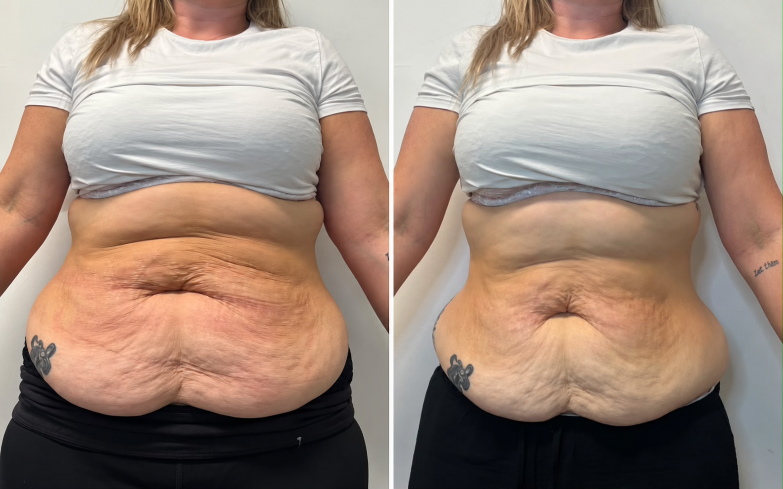 Before treatment on the left and after treatment on the right; clothing digitally edited