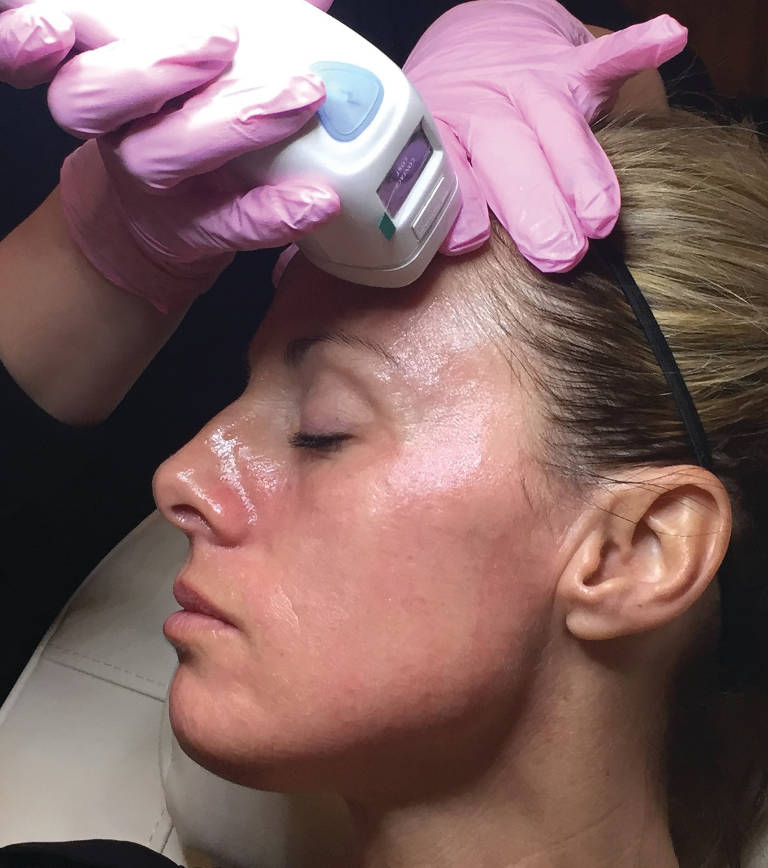 Skin rejuvenation — Emerge laser treatment — photograph 1