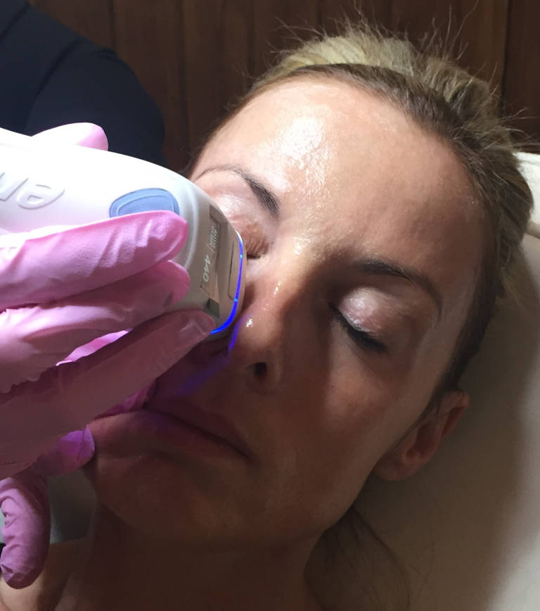 Skin rejuvenation — Emerge laser treatment — photograph 2