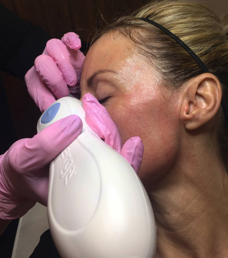 Skin rejuvenation — Emerge laser treatment — photograph 3