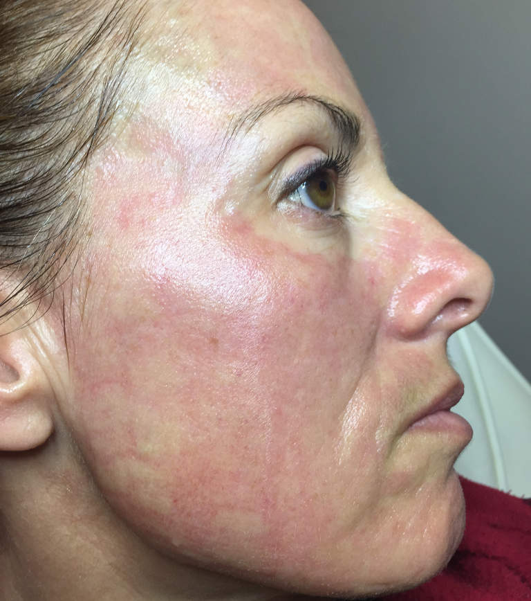 Skin rejuvenation — Immediately after treatment