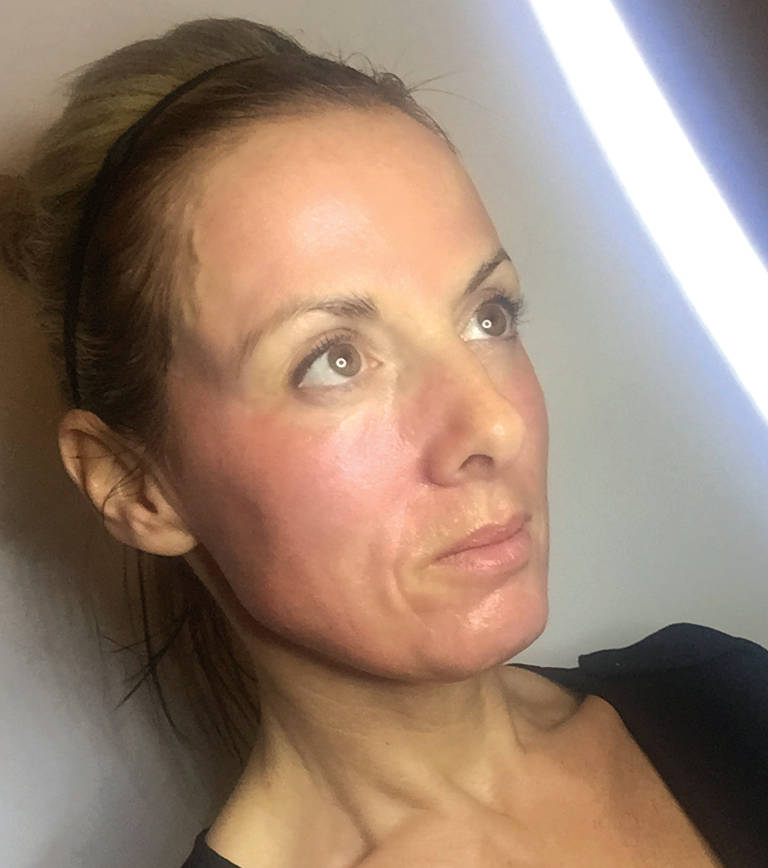 Skin rejuvenation — One hour after treatment