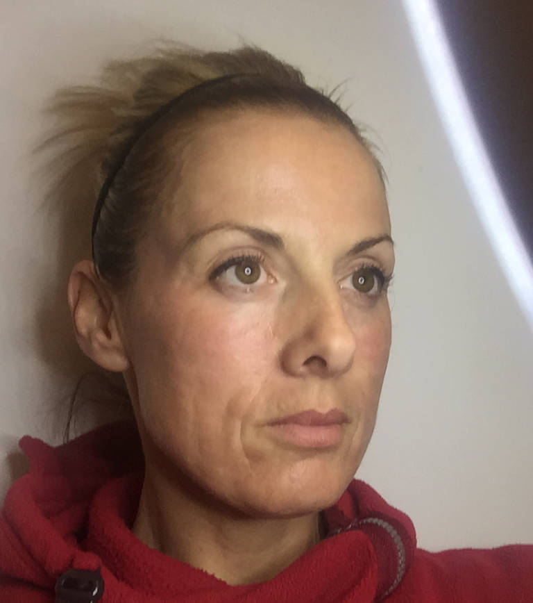 Skin rejuvenation — Later the same day