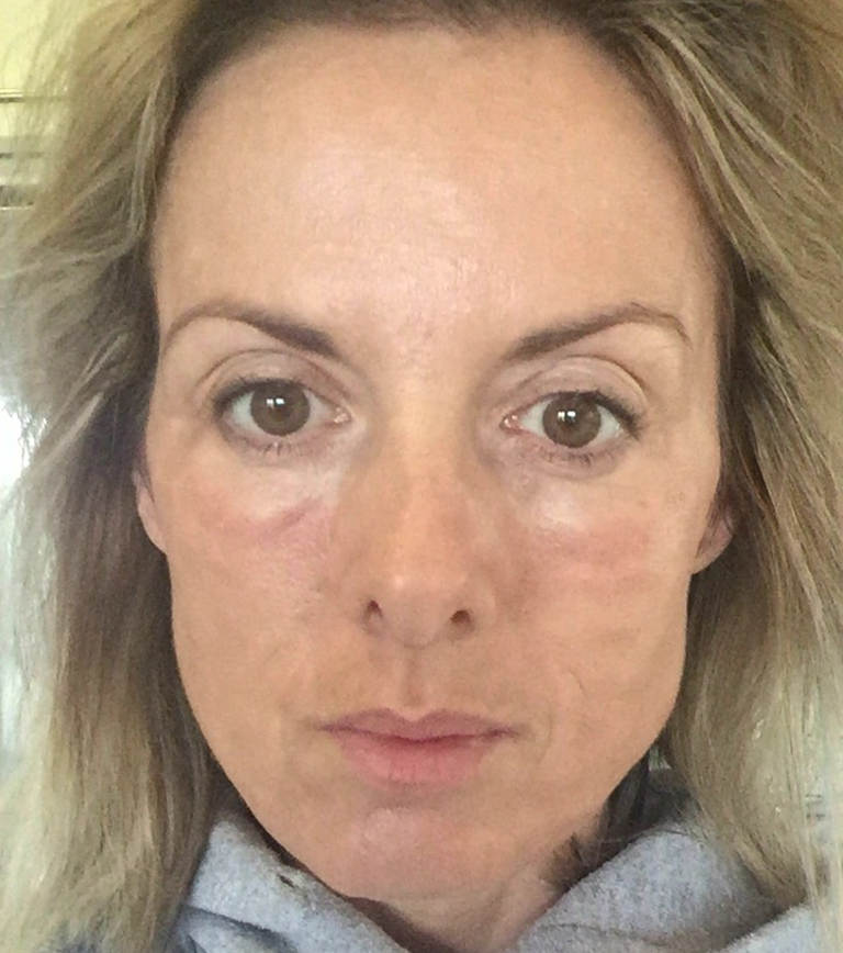 Skin rejuvenation — The morning after treatment