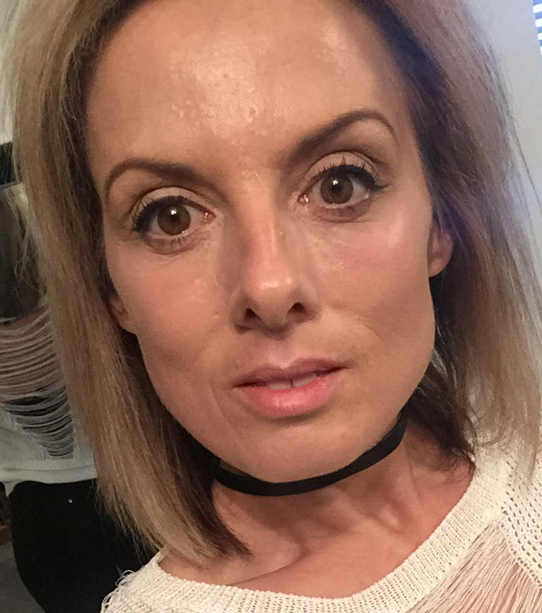 Skin rejuvenation — One week after treatment