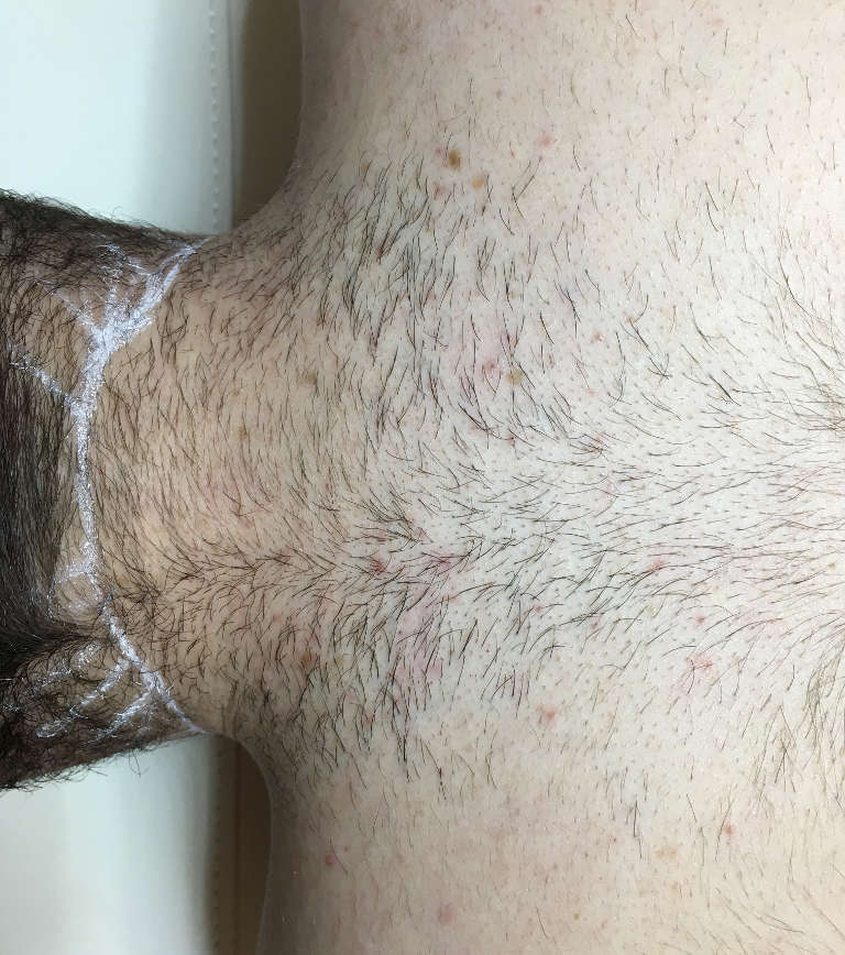 Laser hair removal — Before treatment