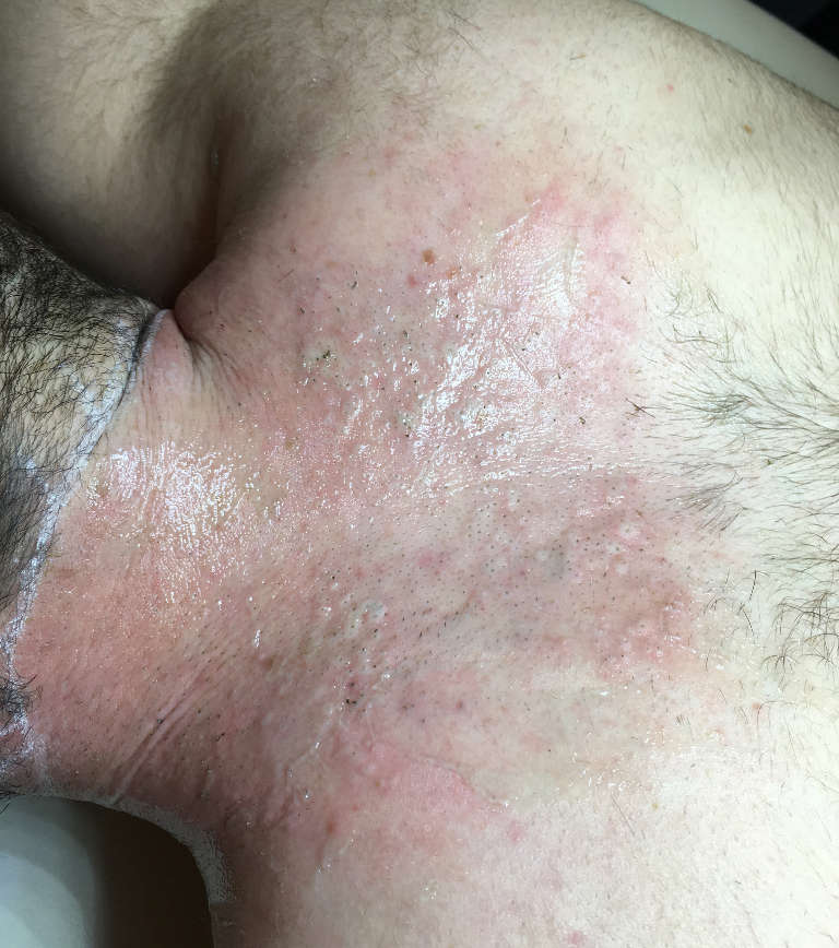 Laser hair removal — Immediately after treatment