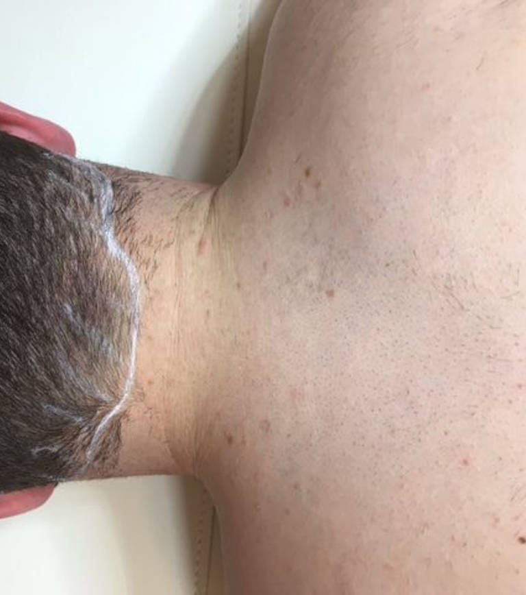 Laser hair removal — Before the second treatment