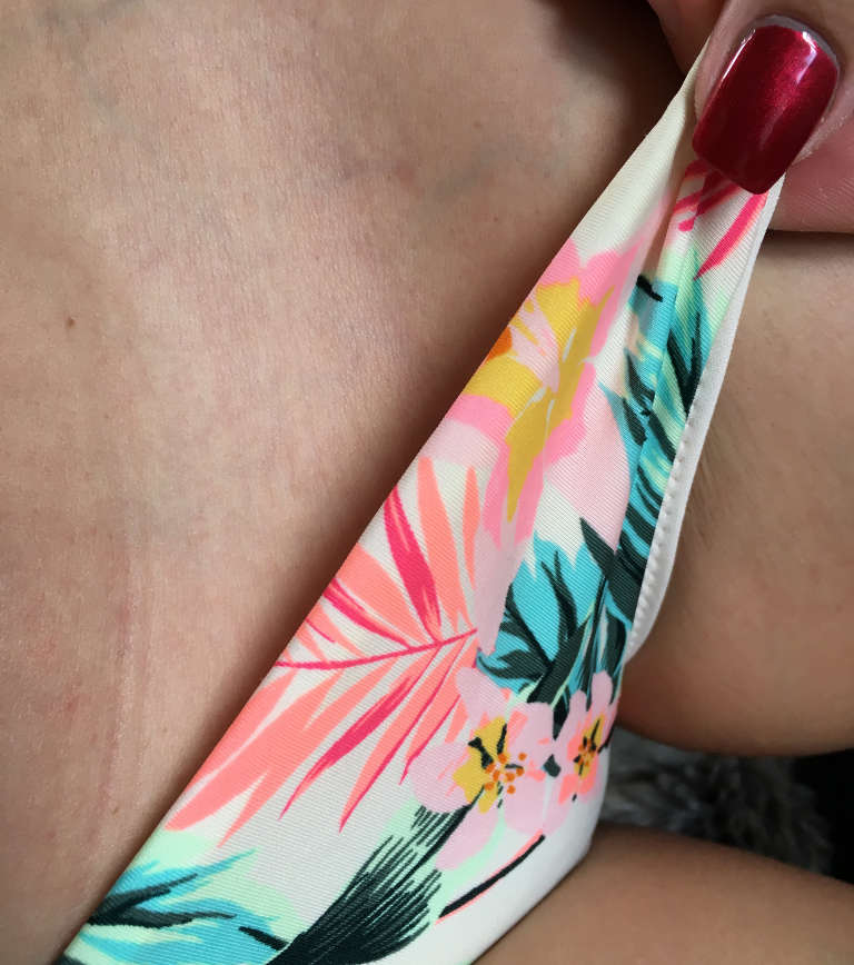 Laser hair removal — Bikini area — two years after the last treatment