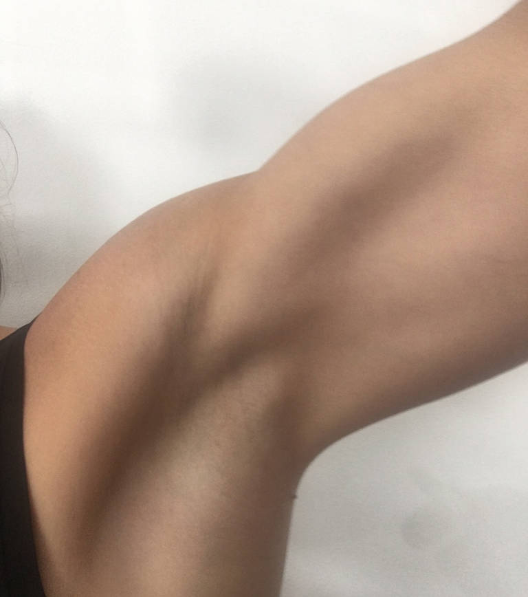 Laser hair removal — Underarms — two years after the last treatment