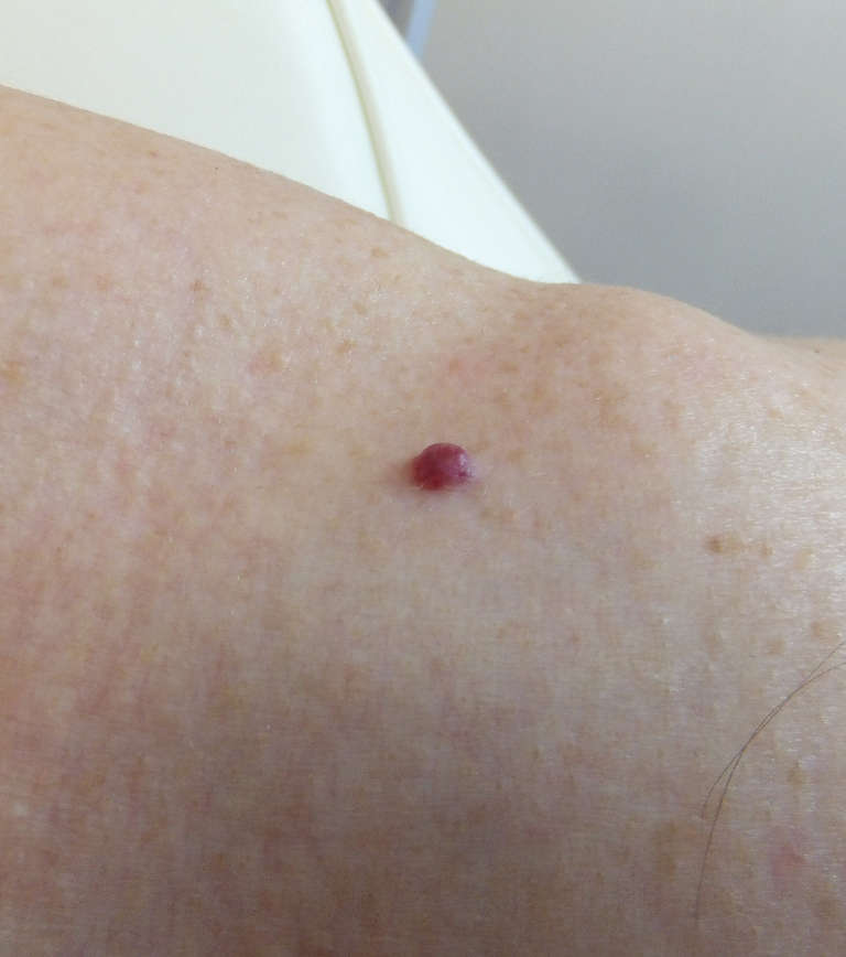 Vascular treatments — Before treatment