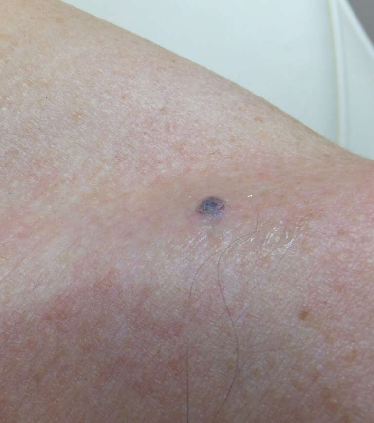 Vascular treatments — Immediately after treatment