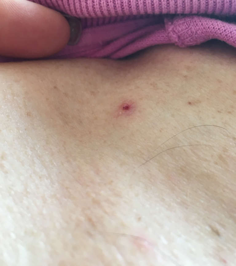 Vascular treatments — Three days after treatment