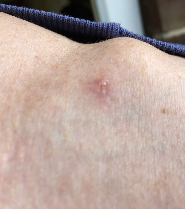 Vascular treatments — One week after treatment