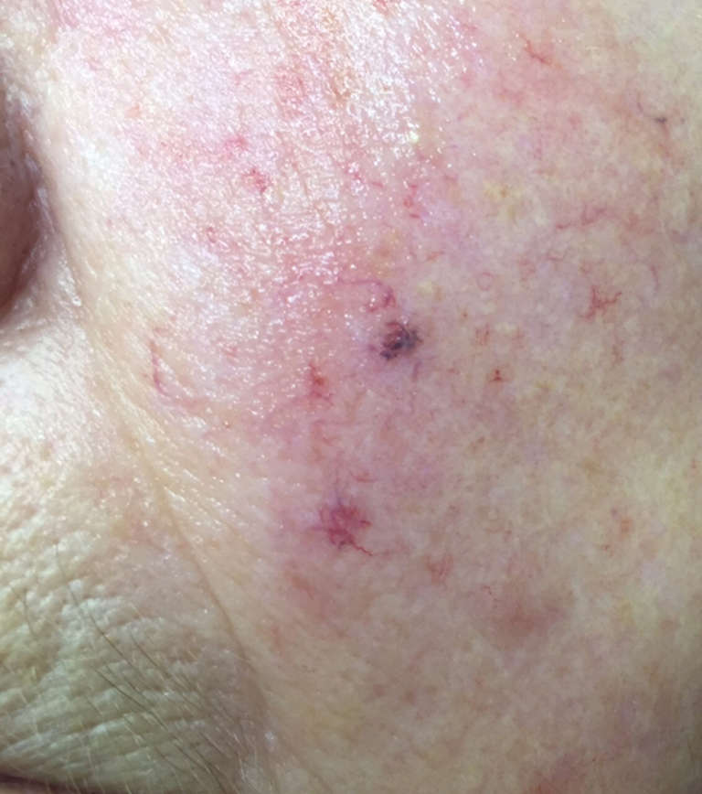 Vascular treatments — Before treatment