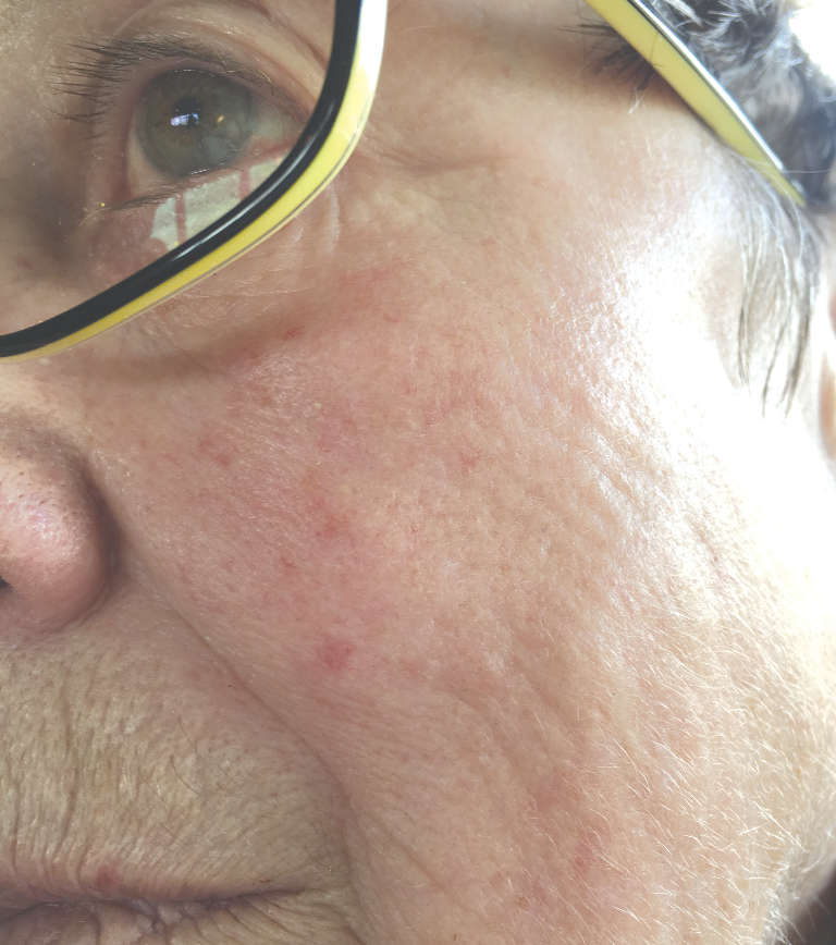 Vascular treatments — After treatment