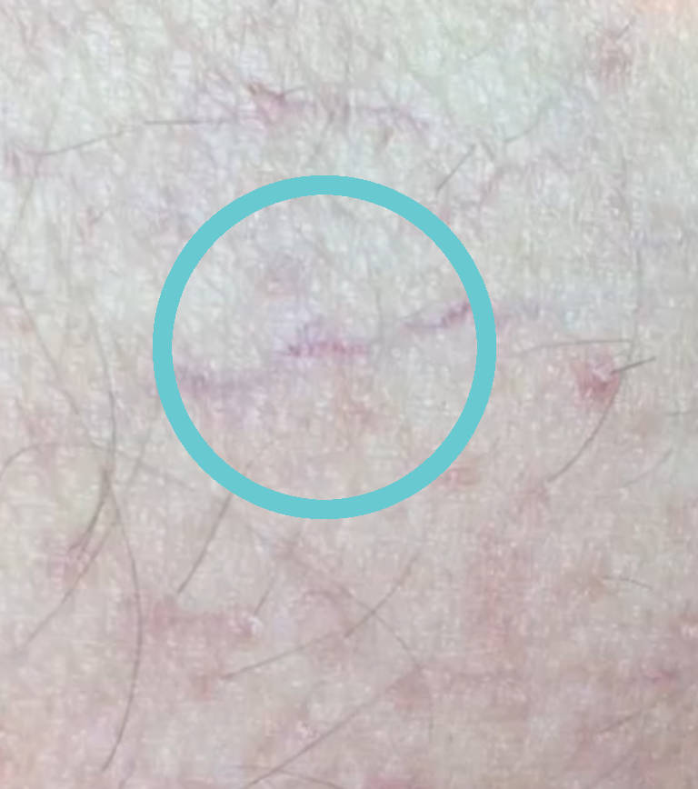 Vascular treatments — Before treatment
