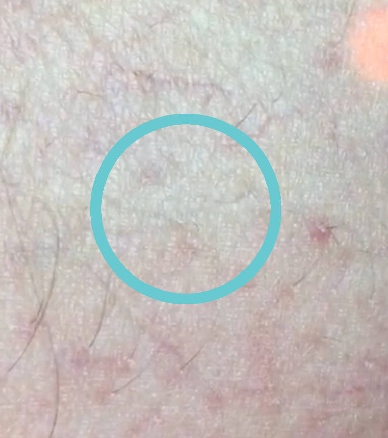 Vascular treatments — After treatment
