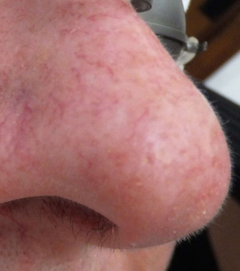 Vascular treatments — Vascular concern — photograph 1