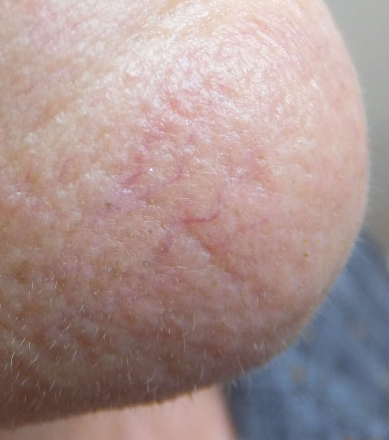 Vascular treatments — Vascular concern — photograph 2