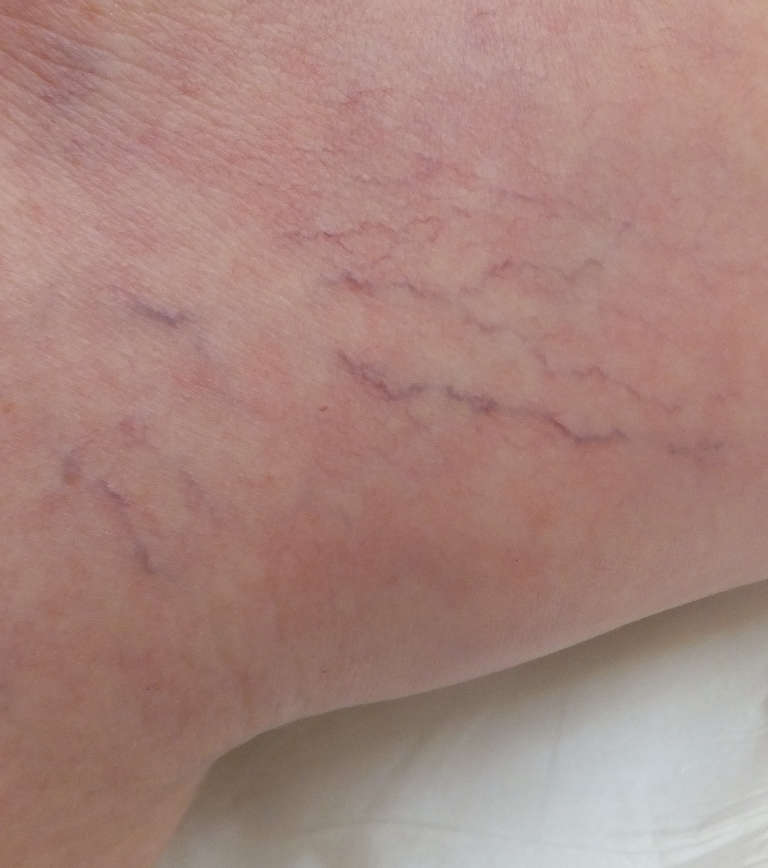 Vascular treatments — Vascular concern — photograph 3