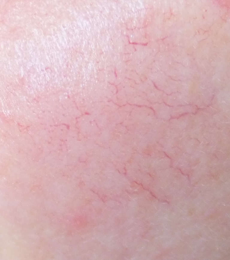 Vascular treatments — Vascular concern — photograph 4